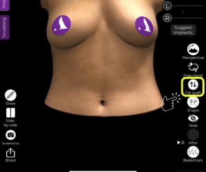 Wählen Sie das Tool Fetttransplantation in der Arbrea Suite