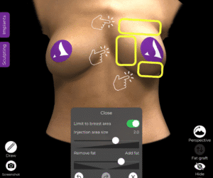 Wo wird das Fetttransplantat in der Arbrea Suite angewendet?