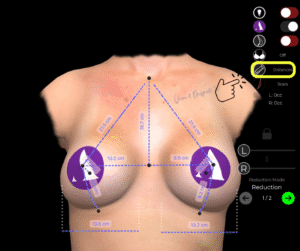 Sehen Sie sich die Brustvermessung der Patientin bei einem Brustimplantat-Ersatz in der Arbrea Suite an