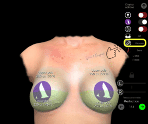 Ansicht des Brustvolumens der Patientin im Fall des Brustimplantat-Ersatzes in der Arbrea Suite