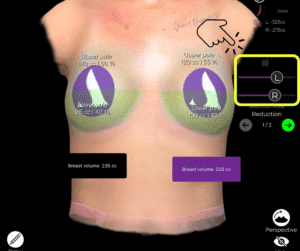 Entfernung des Brustvolumens beim Ersatz von Brustimplantaten in der Arbrea Suite