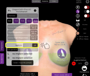 Wählen Sie aus, wo Sie das Implantat bei einem Brustimplantat-Ersatz in der Arbrea Suite einsetzen möchten