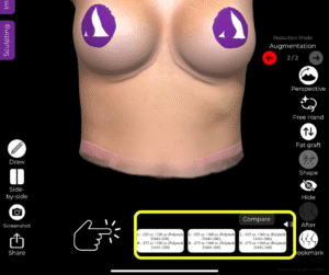 Alle Simulationen im Fall des Ersatzes eines Brustimplantats in der Arbrea Suite anzeigen