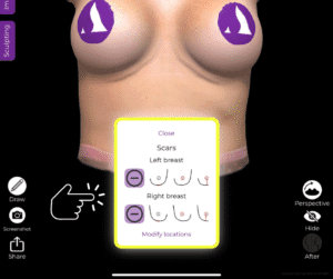 Wahl der Narbenart beim Ersatz von Brustimplantaten in der Arbrea Suite