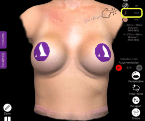 Auswahl des Narbenwerkzeugs beim Ersatz von Brustimplantaten in der Arbrea Suite