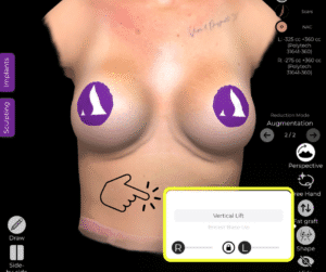 Wählen Sie die gewünschte Änderung im Werkzeug "Form" im Fall des Ersatzes eines Brustimplantats in der Arbrea Suite