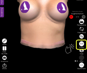 Wählen Sie das Formwerkzeug zur Verfeinerung der Simulation im Fall des Ersatzes eines Brustimplantats in der Arbrea Suite