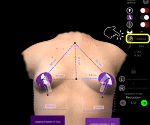 Strumento di misura per il seno tuberoso in Arbrea Suite