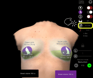 Analisi dei volumi per il seno tuberoso in Arbrea Suite