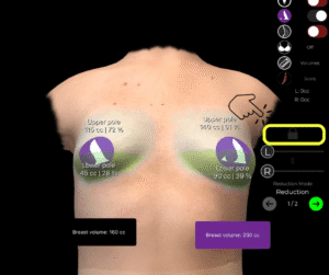 Sbloccare il cursore del volume per il seno tuberoso in Arbrea Suite