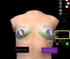 Utilizzare i cursori di volume per il seno tuberoso in Arbrea Suite