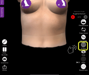Utilizzare lo strumento di forma per il seno tuberoso in Arbrea Suite