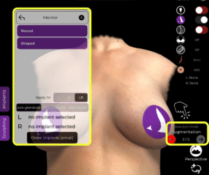 Passare alla modalità di aumento e verificare quali marche di impianti sono disponibili nella modalità di riduzione di Arbrea Suite.