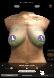 Wie berechnet man Messungen in Arbrea Breast?