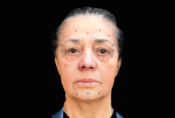 Botox y Rellenos: Cómo Arbrea Face ayuda a simularlos