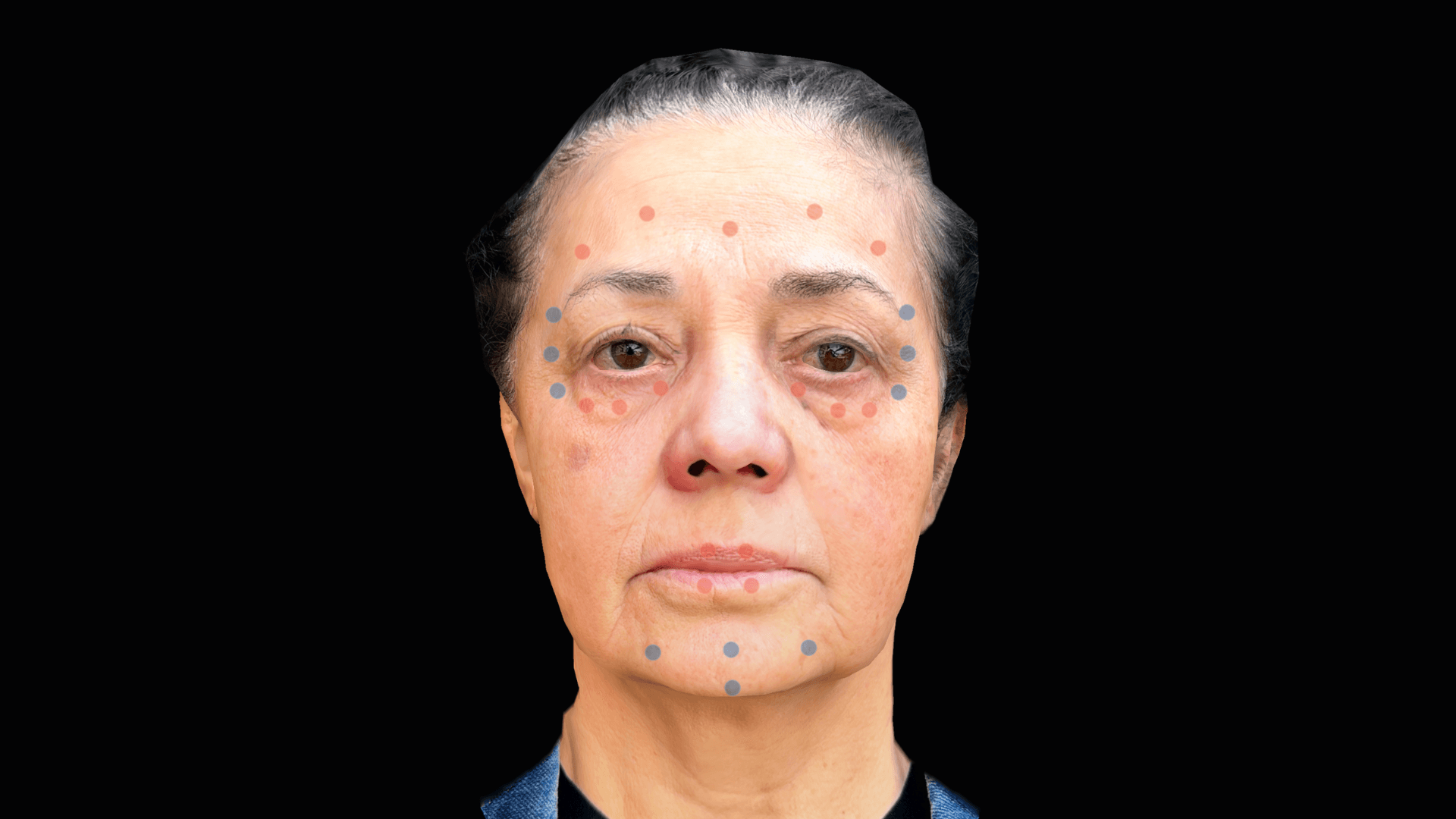 Fronte d'Abrea: La soluzione di simulazione 3D definitiva per botox e filler