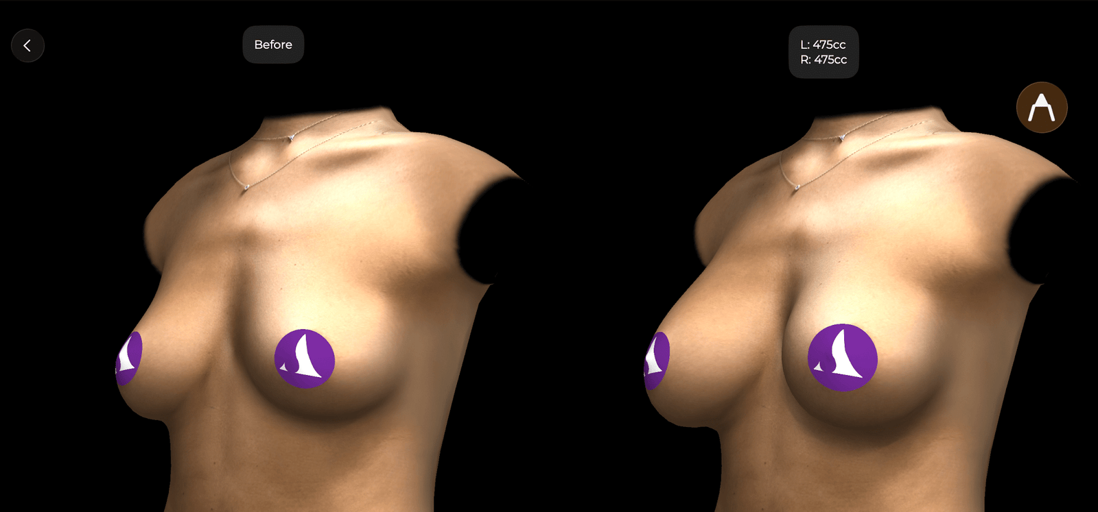 Arbrea Suite — 3D scan next to the simulated outcome